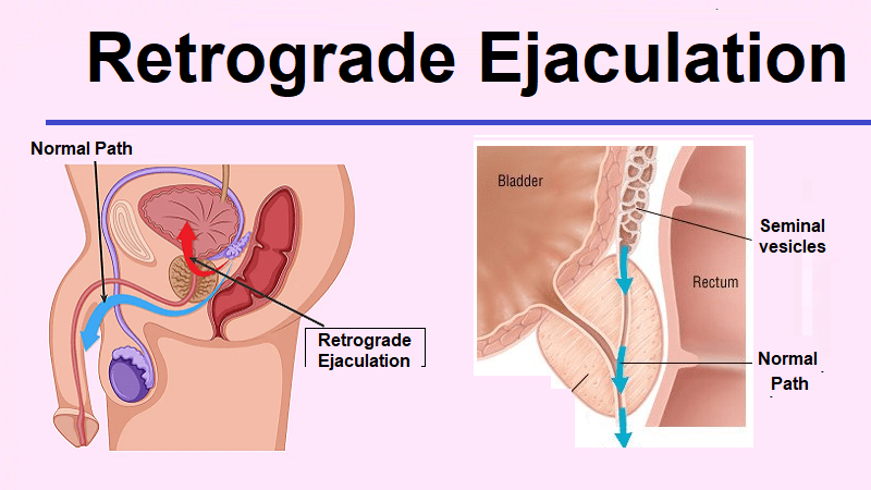 retrogade ejaculation
