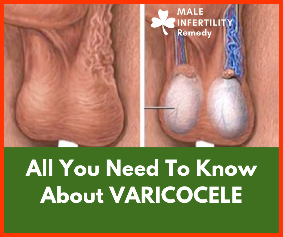 ALL YOU NEED TO KNOW ABOUT VARICOCELE