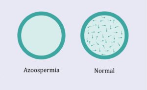 Azoospermia remedy