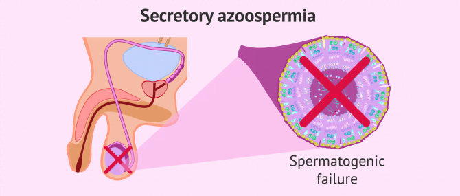 Secretory azoospermia