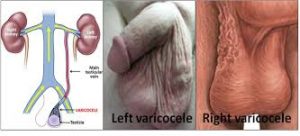 solution for varicocele