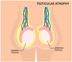 testicular atrophy
